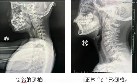9岁女孩沉迷手机颈椎老如50岁（是真的吗）