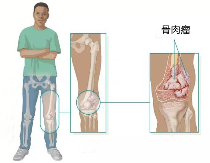 骨癌能治好吗（骨癌可以治愈吗）